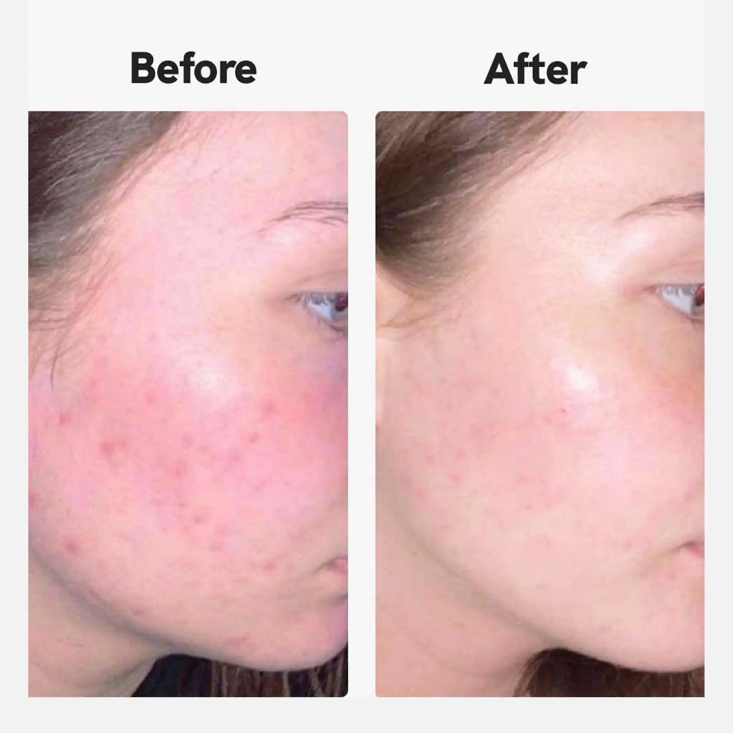 Resultaten van klanten die Nordic Oil's cbd acne crème gebruiken